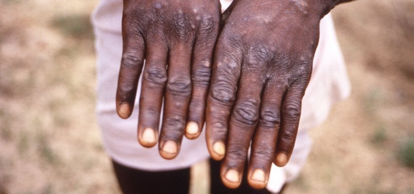 UN health agency declares monkeypox a global emergency UN health agency declares monkeypox a global emergency