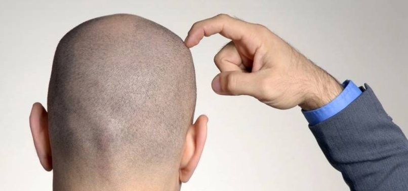 SUGARY DRINKS, ALCOHOL MAY CAUSE HAIR LOSS, STUDY SAYS