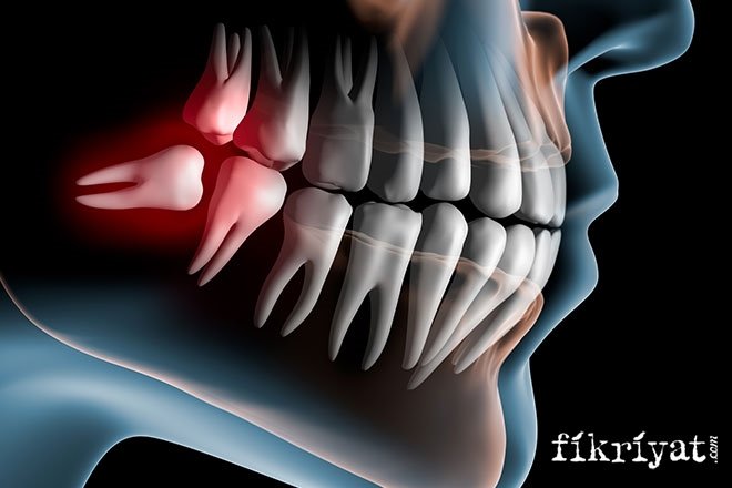 dis agrisina ne iyi gelir evde iltihapli dis agrisina cozum galeri fikriyat gazetesi dis agrisina ne iyi gelir evde iltihapli dis agrisina cozum galeri fikriyat gazetesi
