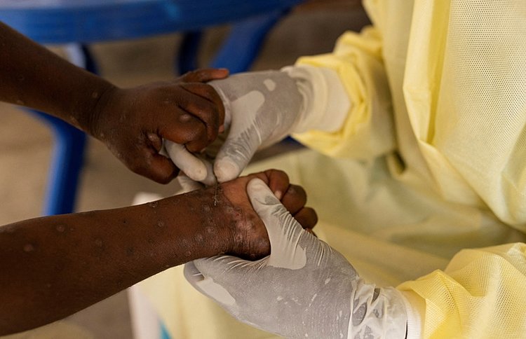 Photo Gallery | MPOX Guide: Here are transmission routes, symptoms, and ...