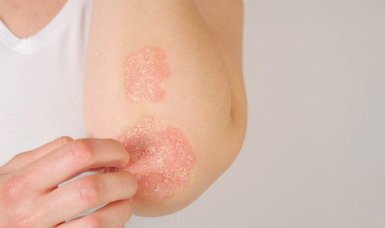 Understanding psoriasis: Causes, prevalence, and treatment