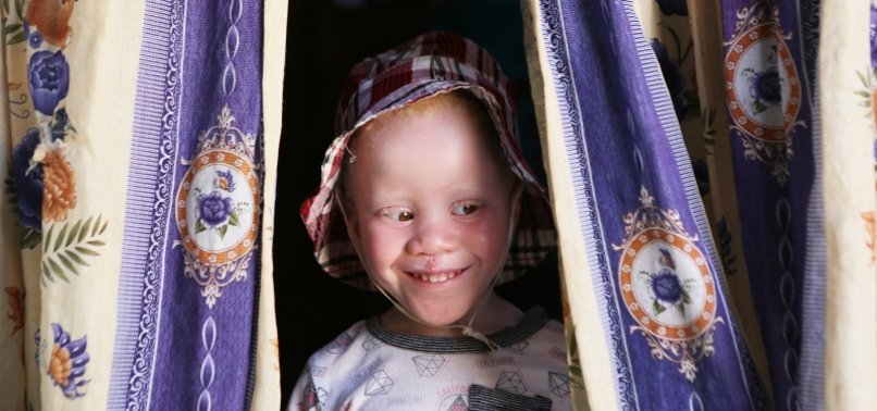 ALBINISM SEEN IN 1 OUT OF 17,000 PEOPLE WORLDWIDE