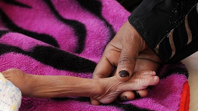 YEMEN’DEKİ AÇLIK FELAKETİ