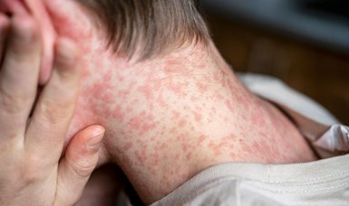 Measles outbreak kills 17 in Indonesia