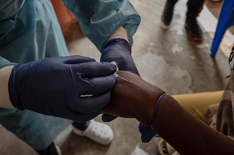 Photo Gallery | MPOX Guide: Here are transmission routes, symptoms, and ...