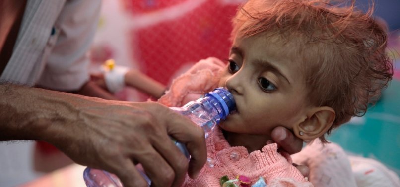HUNGER STALKS CHILDREN IN YEMEN AS UN CUTS AID PROGRAMS