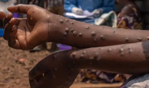 34 Mpox cases detected in Ghana